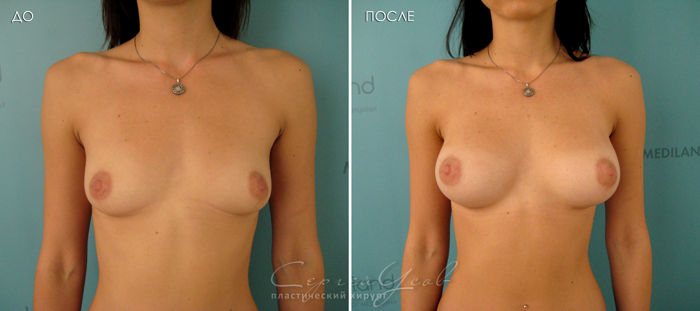 Увеличение груди с помощью имплантатов. 